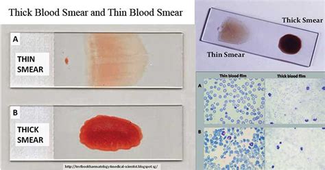 Blood smear Information .